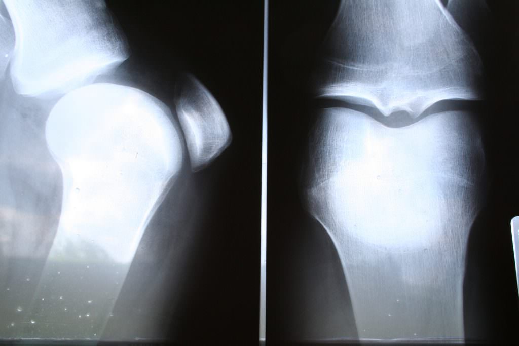 X-Ray of knee